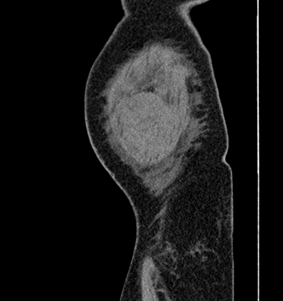 Bilateral rectus sheath hematomas (Radiopaedia 50778-56252 B 77).jpg