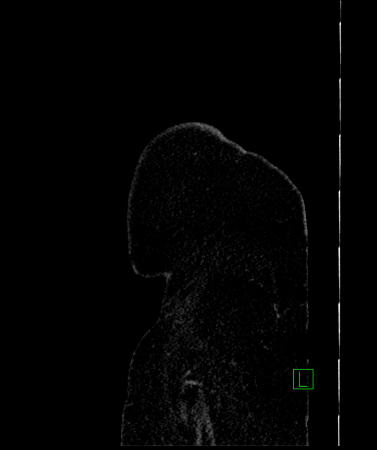 Bilateral sporadic synchronous clear cell renal cell carcinoma (Radiopaedia 85035-100575 E 4).jpg