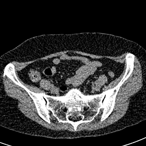 Bilateral staghorn calculi (Radiopaedia 59475-66842 Axial non-contrast 60).jpg
