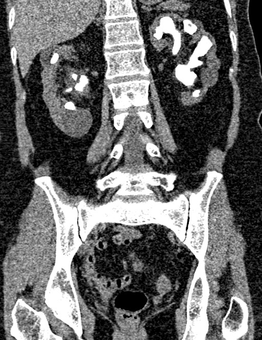 Bilateral staghorn calculi (Radiopaedia 59475-66842 Coronal non-contrast 69).jpg