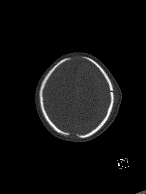 Bilateral subdural hemorrhage and parietal skull fracture (Radiopaedia 26058-26192 Axial bone window 12).png