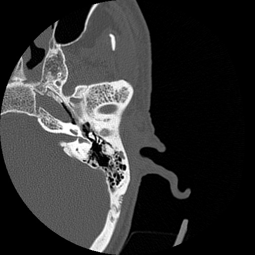Bilateral temporal bone fractures (Radiopaedia 29482-29970 D 81).jpg