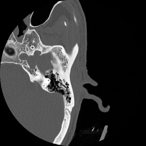 Bilateral temporal bone fractures (Radiopaedia 29482-29970 D 92).jpg