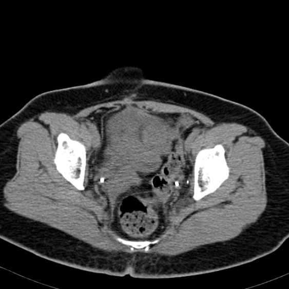 Bilateral ureteric stents (Radiopaedia 48795-53825 Axial non-contrast 59).jpg