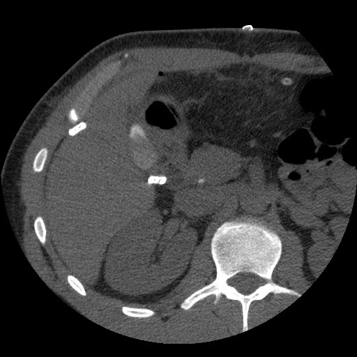 Bile leak from liver traumatic laceration (Radiopaedia 63463-72077 Axial Biliscopin 52).jpg