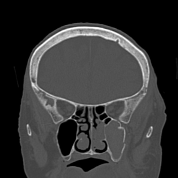 Biparietal osteodystrophy (Radiopaedia 46109-50463 Coronal bone window 35).jpg