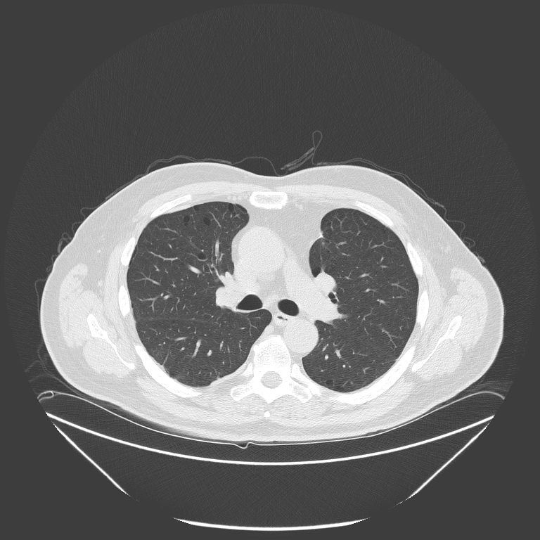 Birt-Hogg-Dubé syndrome (Radiopaedia 52578-58491 Axial lung window 25).jpg