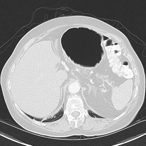 Bladder and bowel cancers (Radiopaedia 37688-39592 Axial lung window 50).png