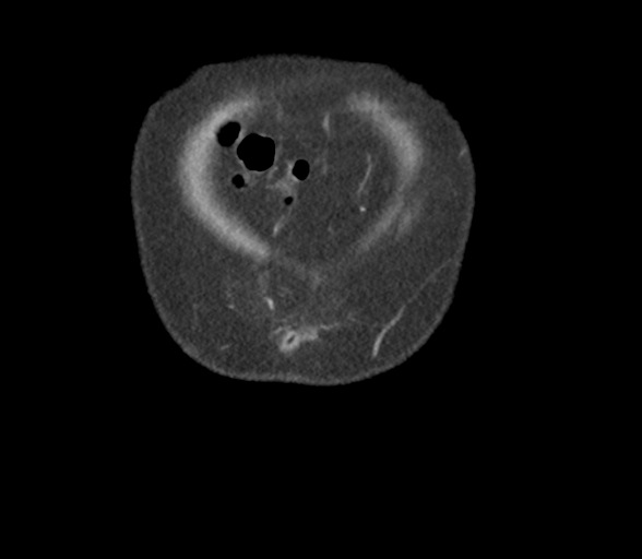 Bladder papillary urothelial carcinoma (Radiopaedia 48119-52951 C 4).png