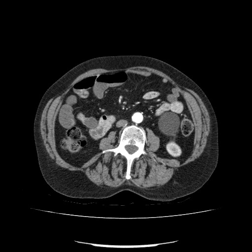 Bladder tumor detected on trauma CT (Radiopaedia 51809-57609 A 122).jpg