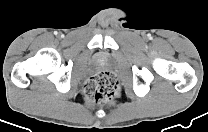 Blunt injury to the small bowel (Radiopaedia 74953-85987 A 194).jpg