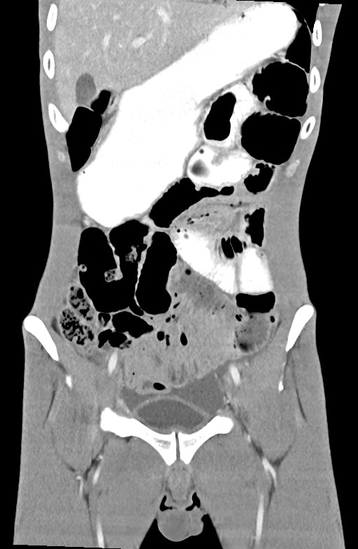Blunt injury to the small bowel (Radiopaedia 74953-85987 B 32).jpg