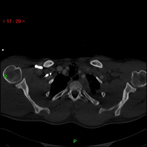 Blunt thoracic trauma (Radiopaedia 73454-84221 Axial bone window 12).jpg