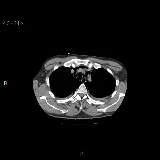 Boerhaave syndrome (Radiopaedia 27683-27897 Axial non-contrast 24).jpg