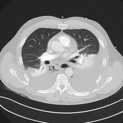 Boerhaave syndrome (Radiopaedia 39382-41660 Axial lung window 27).png