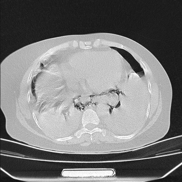 Boerhaave syndrome (Radiopaedia 45644-49799 Axial lung window 82).jpg