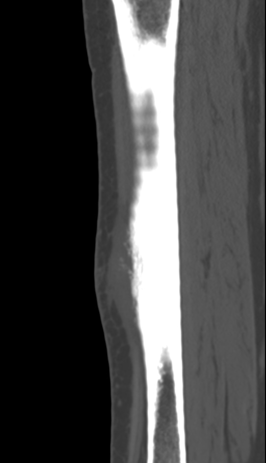 Bone metastasis - tibia (Radiopaedia 57665-64609 Sagittal bone window 104).jpg