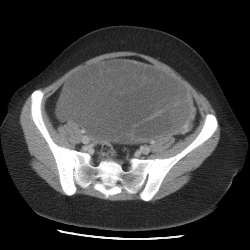 File:Borderline mucinous tumor (ovary) (Radiopaedia 78228-90808 A 116).jpg