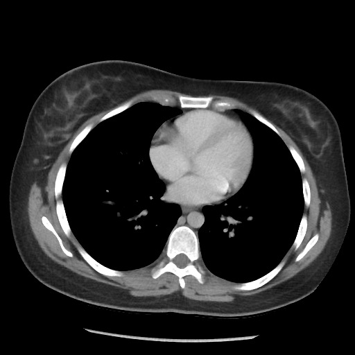 File:Borderline mucinous tumor (ovary) (Radiopaedia 78228-90808 A 56).jpg
