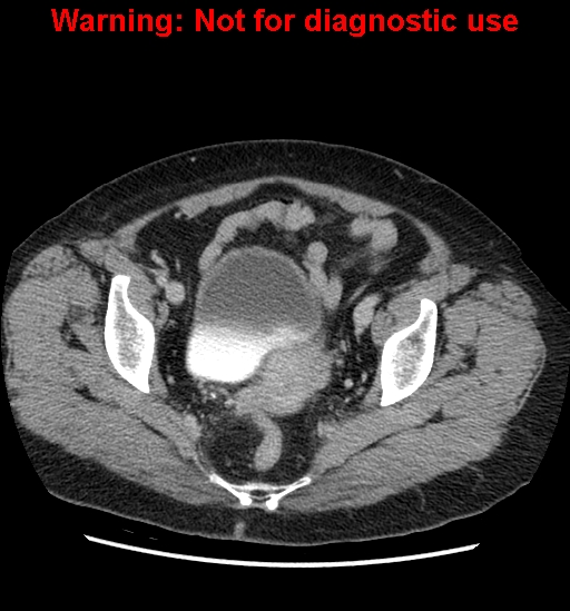 File:Bosniak renal cyst - type II (Radiopaedia 23404-23468 F 58).jpg