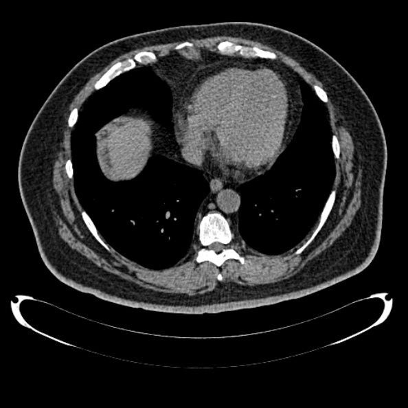 Bosniak renal cyst - type IV (Radiopaedia 24244-24518 Axial non-contrast 7).jpg