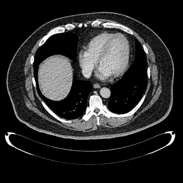 Bosniak renal cyst - type IV (Radiopaedia 24244-24518 C 1).jpg