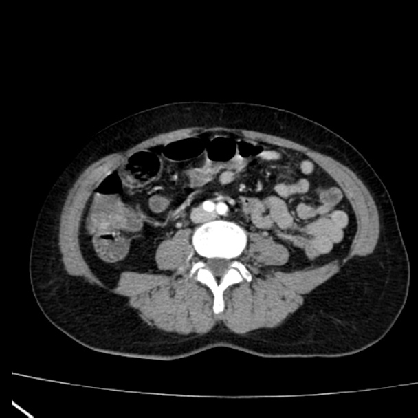 Bosniak renal cyst - type I (Radiopaedia 27479-27675 renal cortical phase 54).jpg