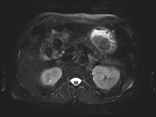 File:Bouveret syndrome (Radiopaedia 61017-68856 Axial MRCP 23).jpg