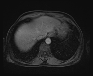 File:Bouveret syndrome (Radiopaedia 61017-68856 Axial T1 C+ fat sat 12).jpg