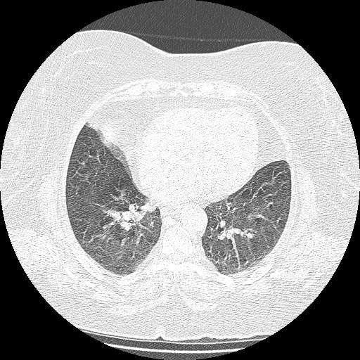 Bovine aortic arch - right internal mammary vein drains into the superior vena cava (Radiopaedia 63296-71875 Axial lung window 106).jpg