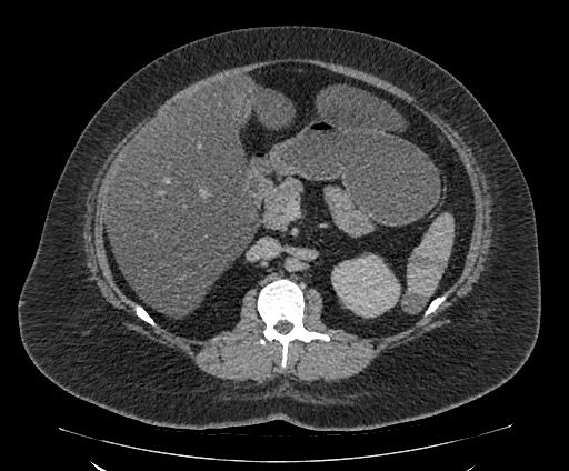 Bowel and splenic infarcts in acute lymphocytic leukemia (Radiopaedia 61055-68913 A 54).jpg