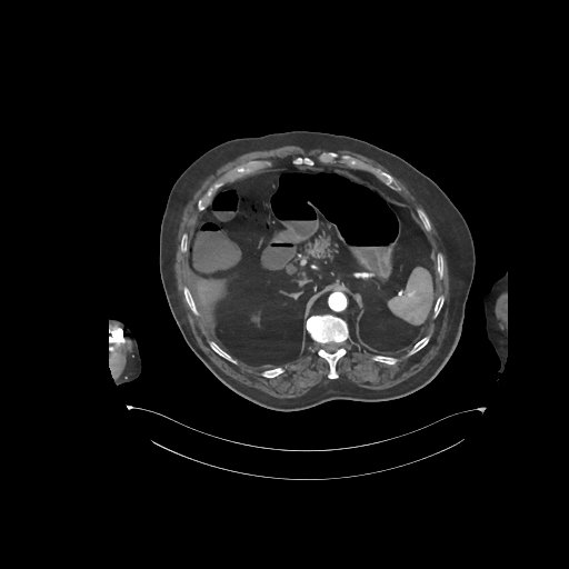 File:Bowel ischemia secondary to SMA occlusion with extensive portomesenteric venous gas (Radiopaedia 54656-60871 A 58).jpg