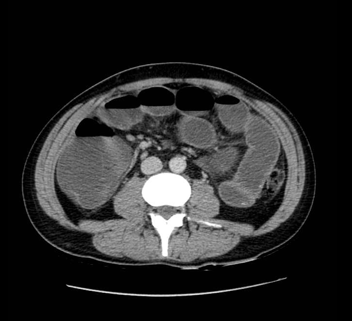 Bowel obstruction from colon carcinoma (Radiopaedia 22995-23028 A 45).jpg