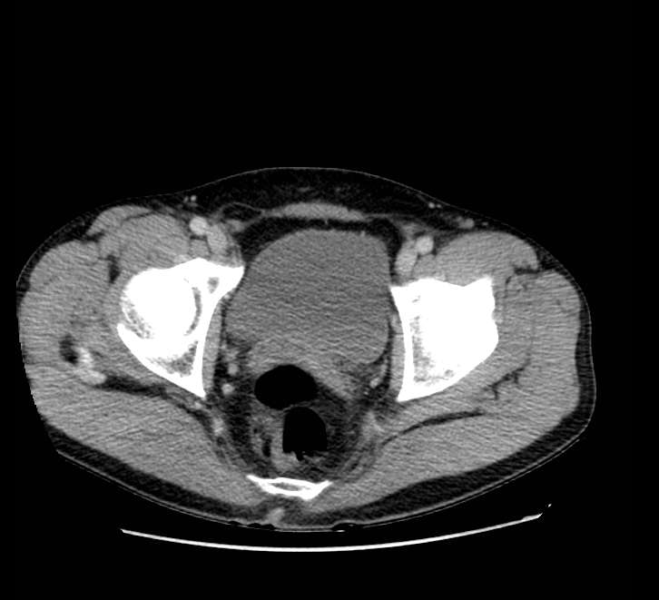 Bowel obstruction from colon carcinoma (Radiopaedia 22995-23028 A 80).jpg