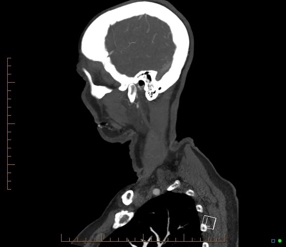 Brachiocephalic trunk stenosis (Radiopaedia 87242-103519 C 9).jpg