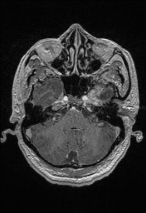 Brain abscess with ventriculitis (Radiopaedia 85703-101495 Axial T1 C+ 46).jpg