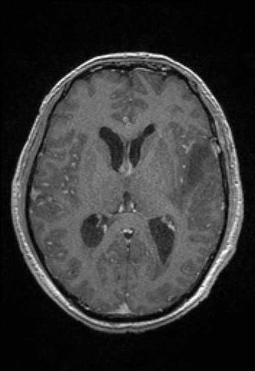 Brain abscess with ventriculitis (Radiopaedia 85703-101495 Axial T1 C+ 96).jpg