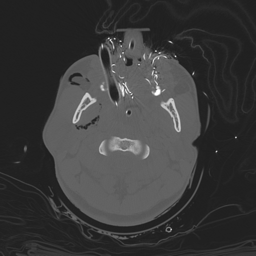 File:Brain contusions, internal carotid artery dissection and base of skull fracture (Radiopaedia 34089-35339 Axial bone window 29).png