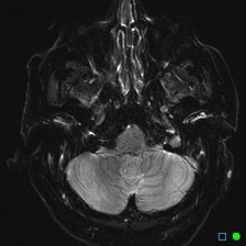 File:Brain death on MRI and CT angiography (Radiopaedia 42560-45689 Axial ADC 8).jpg