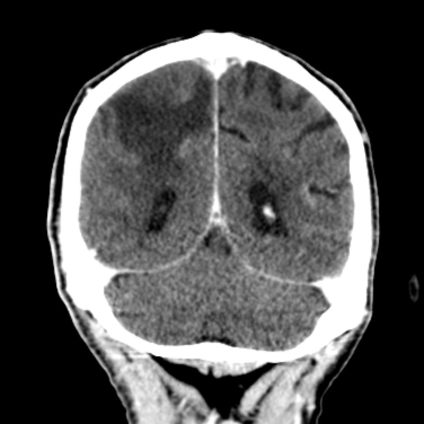 Brain metastases from lung cancer (Radiopaedia 27849-28092 Coronal C+ delayed 50).jpg