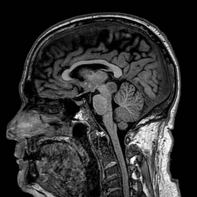 Brain metastases from lung cancer (Radiopaedia 83839-99028 Sagittal T1 63).jpg
