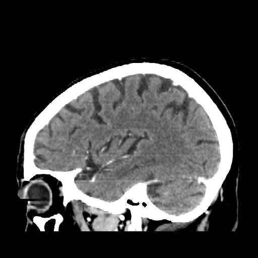 Brain metastasis (Radiopaedia 42617-45760 D 11).jpg