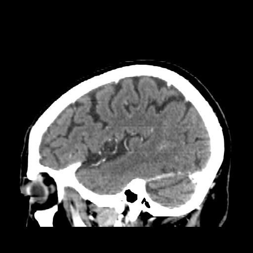 Brain metastasis (Radiopaedia 42617-45760 D 9).jpg