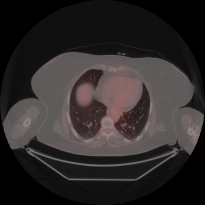 Brain metastasis (Radiopaedia 89847-106962 Axial lung window 41).jpg
