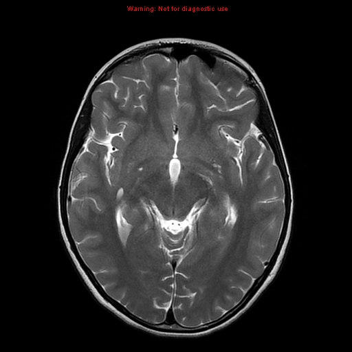 File:Brainstem glioma (Radiopaedia 9444-10124 Axial T2 10).jpg