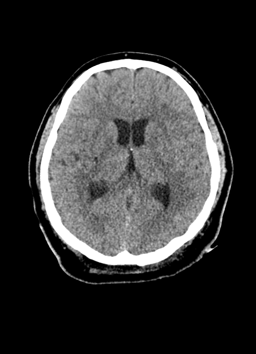 Brainstem hemorrhage (Radiopaedia 81294-94976 Axial non-contrast 31).jpg