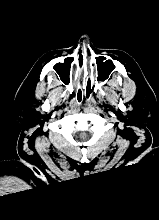 Brainstem hemorrhage (Radiopaedia 81294-94976 Axial non-contrast 62).jpg