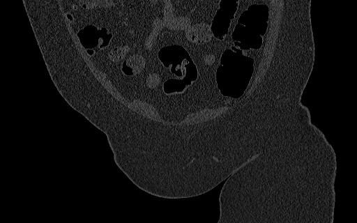 Breast carcinoma with pathological hip fracture (Radiopaedia 60314-67993 Coronal bone window 38).jpg