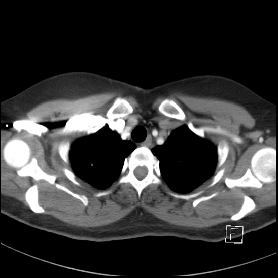 File:Breast metastases from renal cell cancer (Radiopaedia 79220-92225 A 15).jpg