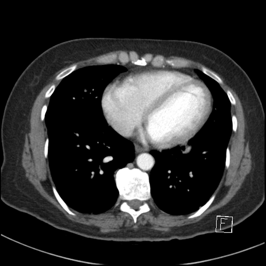 File:Breast metastases from renal cell cancer (Radiopaedia 79220-92225 A 63).jpg